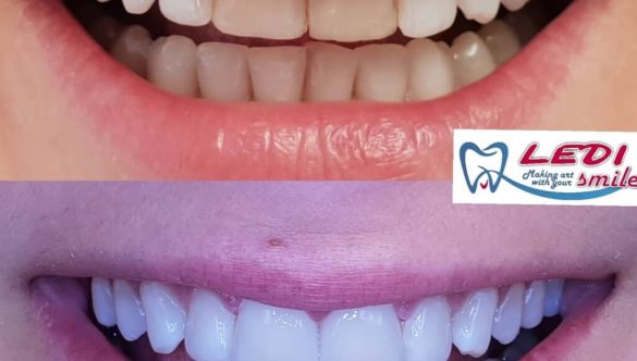 Emax Veneers