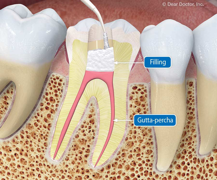 filling