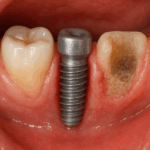 Can You Get a Dental Implant If You Have No Bone?