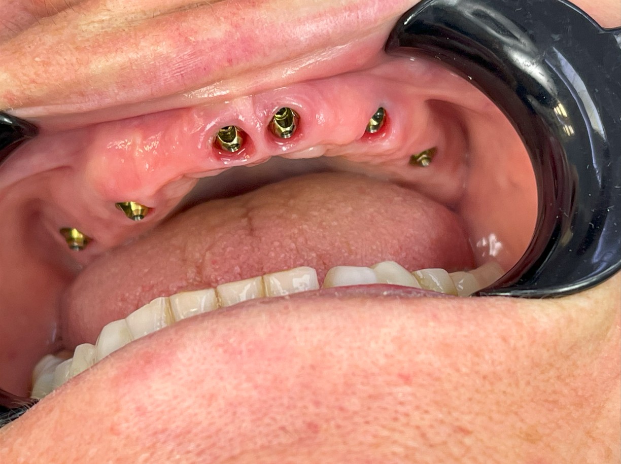Did You Know That a Correctly Placed Dental Implant Can Last a Lifetime?