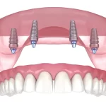 How Many Teeth Can Be Replaced with Just 4 Implants?